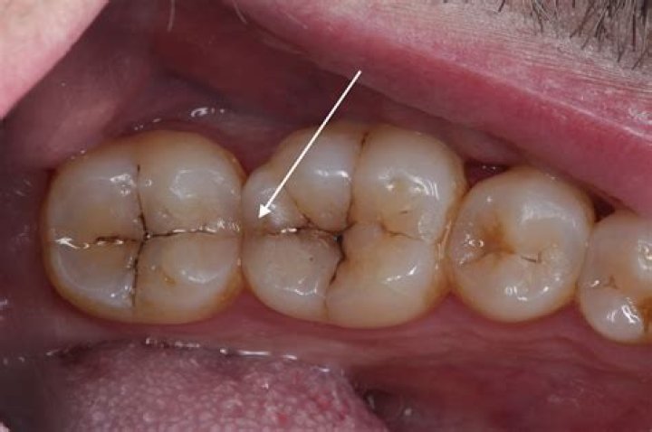 Broken Tooth Brown Inside - How To Discuss